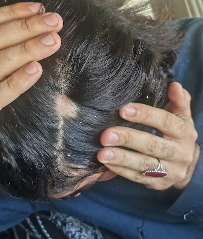 Dr Ahsen MD, ABHRS(US) Hair Transplant Surgeon Abudhabi Dubai UAE - Abu Dhabi - +971 50 129 8697