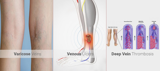 Vein Clinic - Umm Al Quawain - +971 58 584 6935